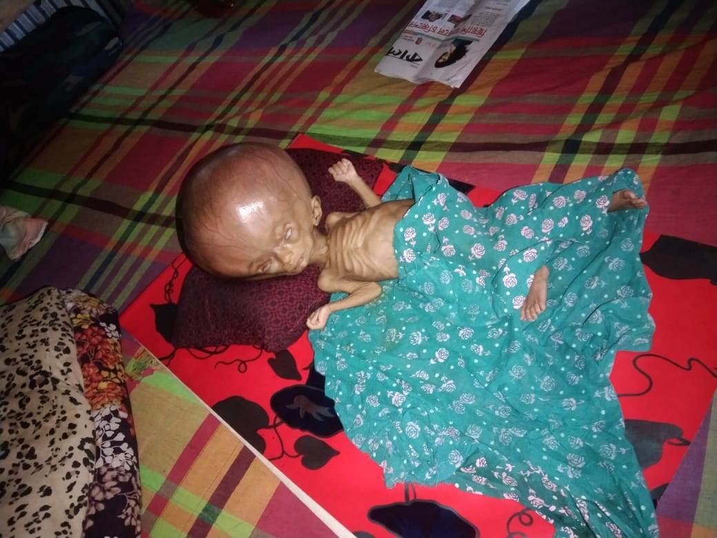 কাউনিয়ায় টাকার অভাবে থেমে গেছে ৫ মাসের শিশু আসছিয়া জান্নাতের চিকিৎসা